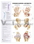 Understanding Arthritis Anatomical Chart